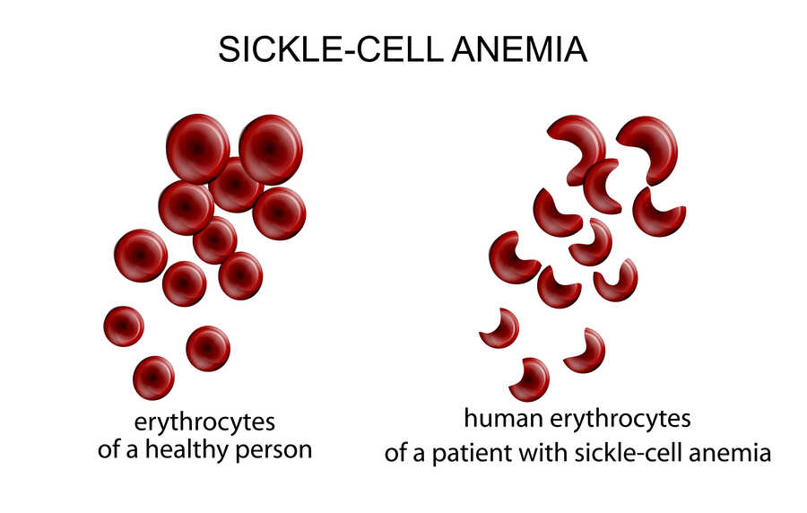 Do White People Have Sickle Cell Trait